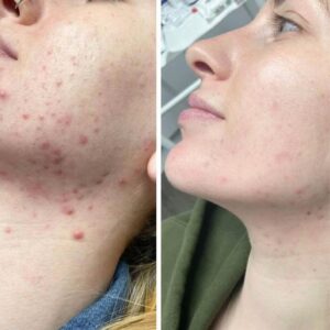 TCA Peel 20% Superior Grade Trichloroacetic Acid Chemical Skin Peel To Remove Acne And Fade Acne Marks,1oz/30ml With Neutralizer 100ml Hover