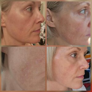 Phenol Peel Professional Facial Exfoliant 30ml / 1oz – Advanced Cosmetic Skin Resurfacing Solution for Smooth Looking Texture & Refined Appearance Hover
