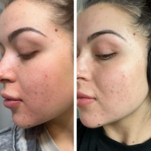 TCA 60% Trichloroacetic Acid Chemical Skin Peel To Remove Acne And Fade Acne Marks,1oz/30ml Hover