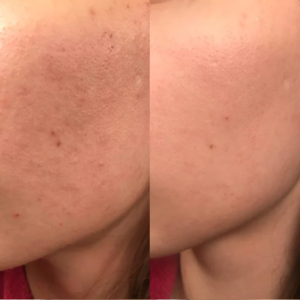 Lactic Acid 80% Chemical Peel 30ml / 1oz – Professional AHA Facial Exfoliant for Skin Resurfacing, Smooth Looking Texture & Hydrated Appearance Hover